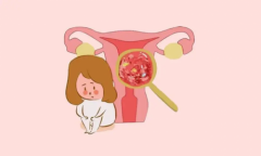 成都锦江妇幼妇科专家分享：得了子宫肌瘤的7个症状，快来自查！