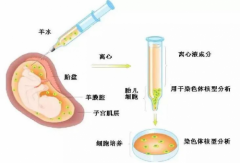 内江市妇幼产科医生：关于羊水穿刺这五点要知道！