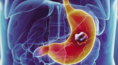 初步认识什么是胃癌？
