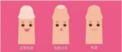 内江市妇幼专家分享：几岁适合割包皮？